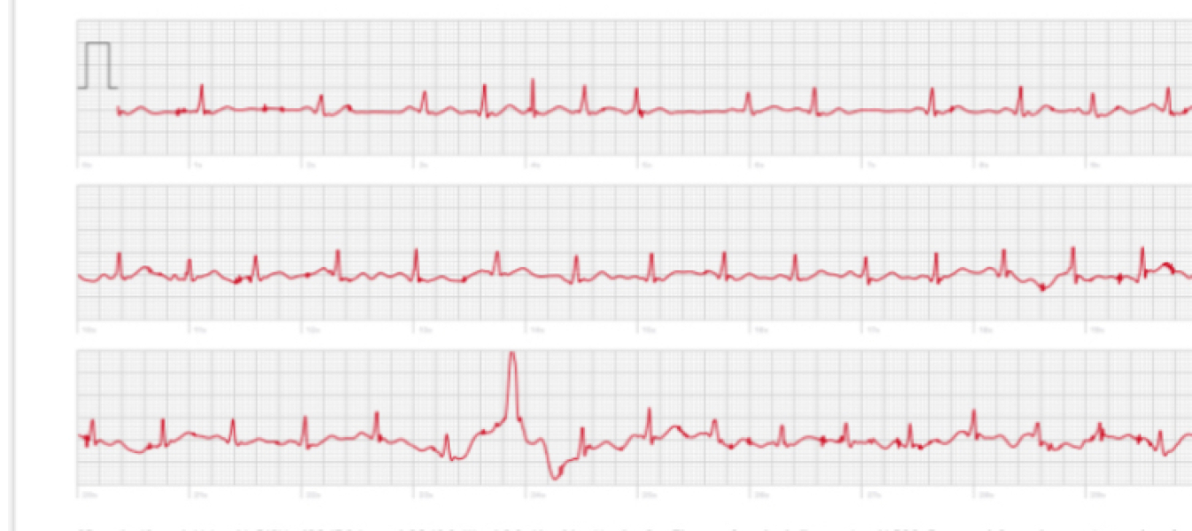 Apple Watch ECG - is this SVT?