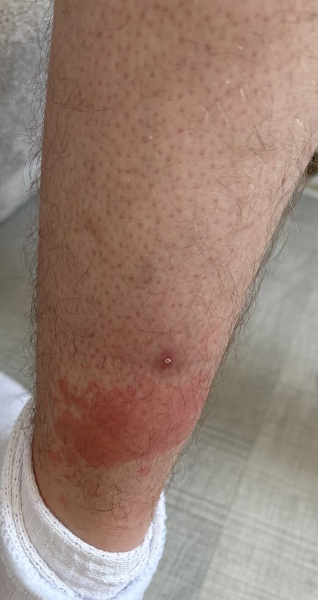 Rash on leg