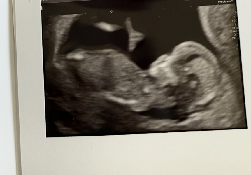 NT fluid on scan