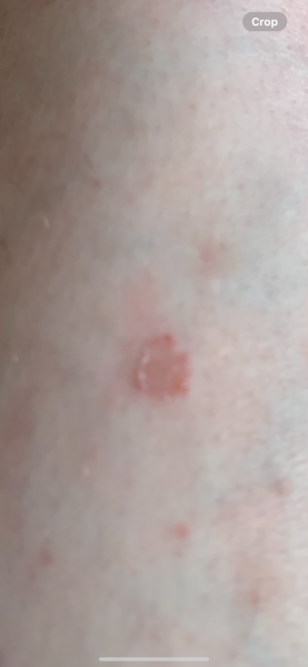 What’s this on my leg