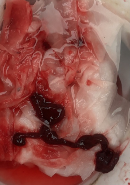 Warning photo, does this size period blood clot look normal to you