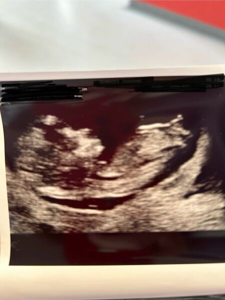 Gender guesses of 12 week scan? 💙🩷