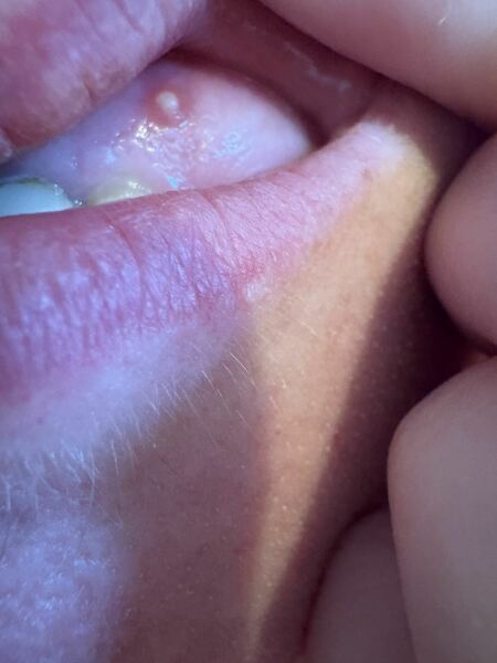 Gum lesion?