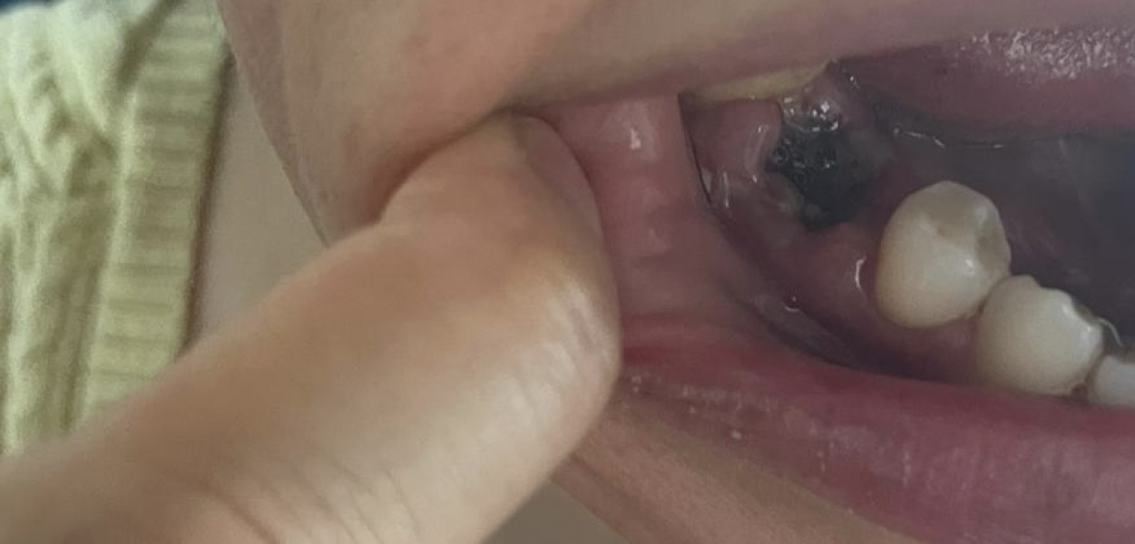 Tooth extraction - dry socket ?