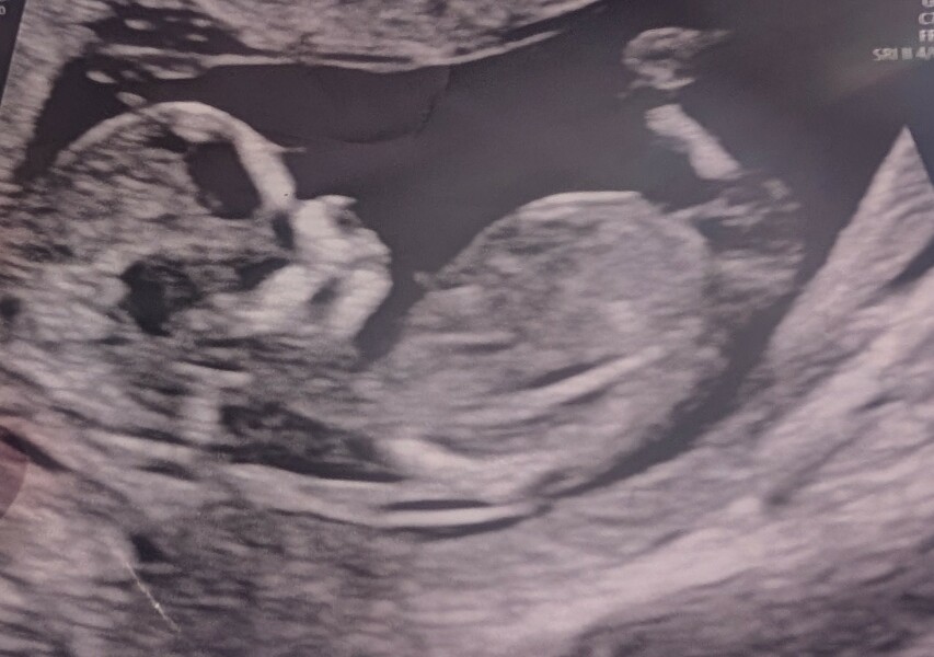 Based on the nub theory- boy or girl?