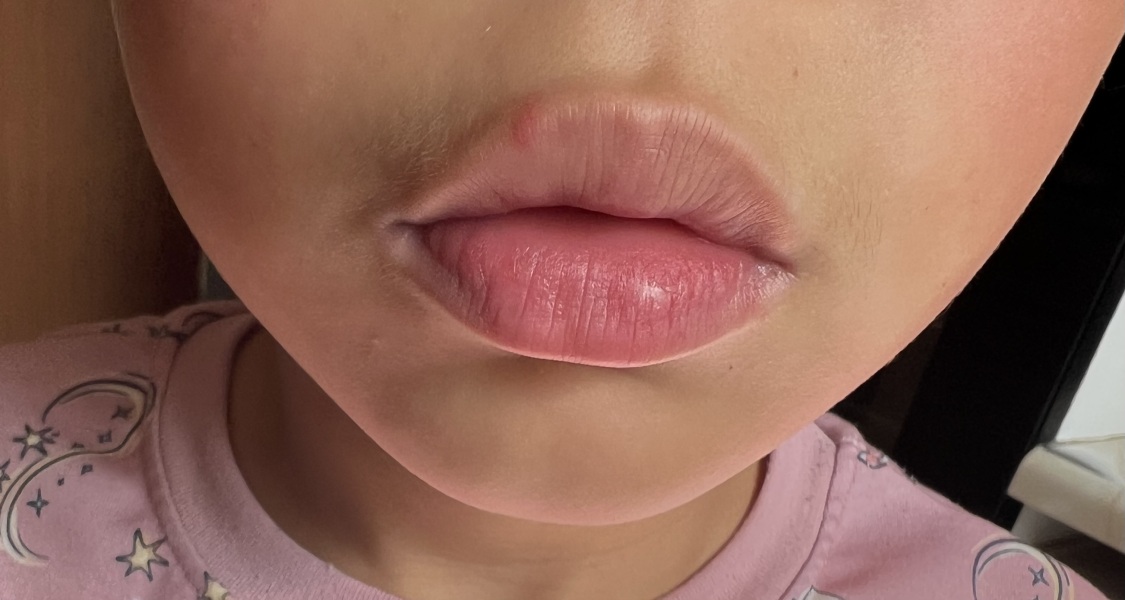 DD7 cold sores