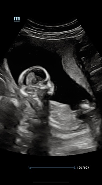 Gender scan