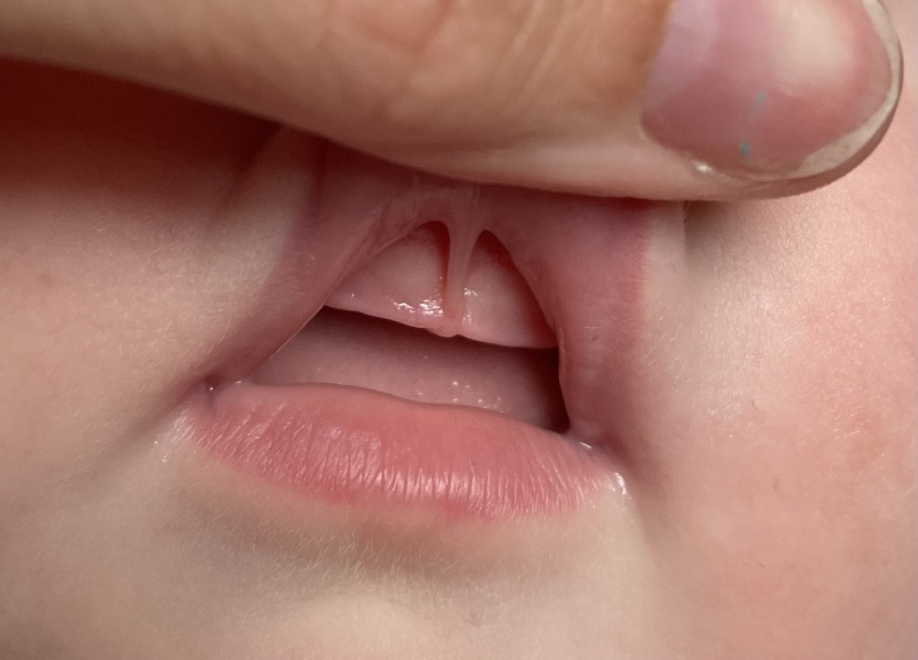 Anyone with lip tie experience?