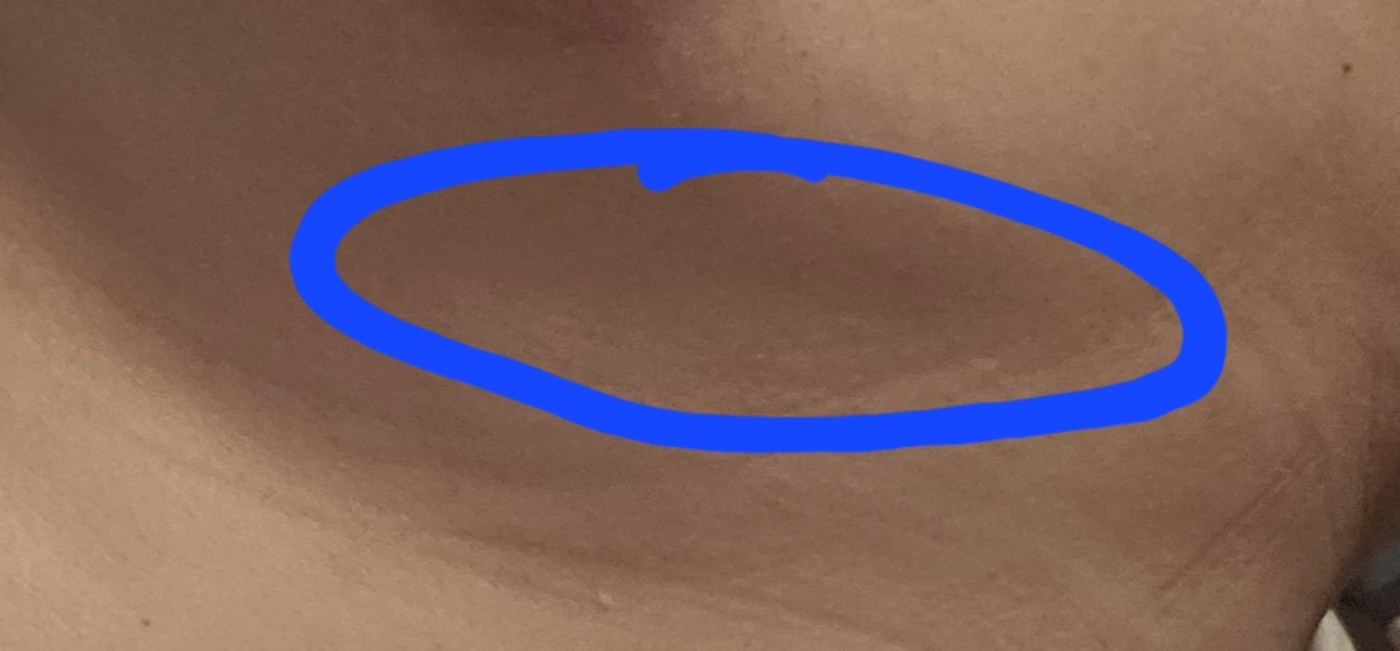Breast pain/indent under breast