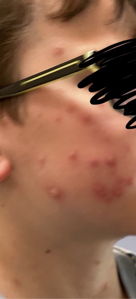 Are these chickenpox infected?