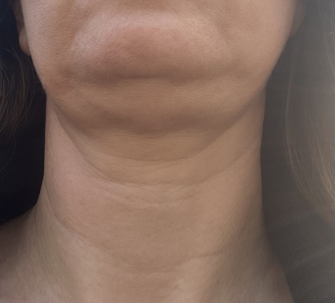 Crepe neck help!