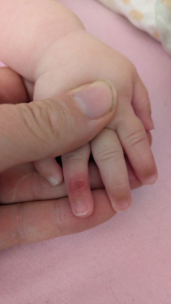 Weird thing on baby finger