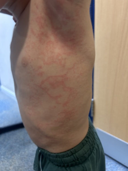 2 year old rash for nearly 2 weeks now