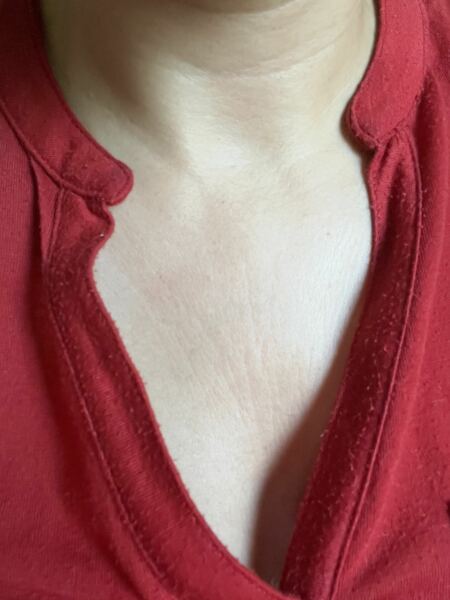 Chest lines- any way to get rid?