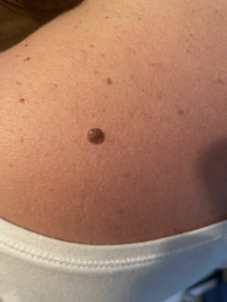 Seborrheic Keratosis miracle cure