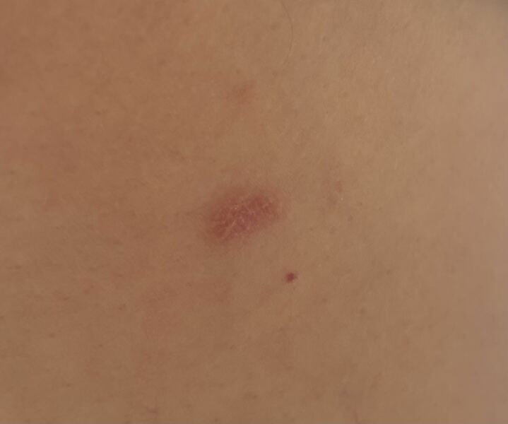 Is this skin cancer?