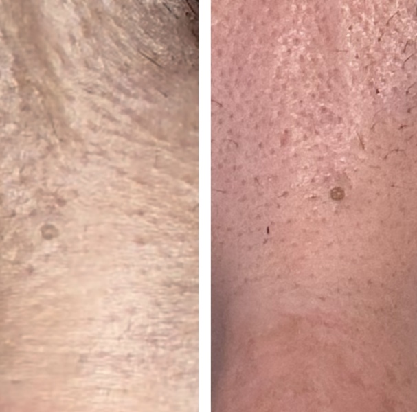 Should I be worried about this mole between my eyes (top of nose)?