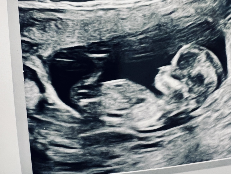 Girl or boy - 13 week scan just for fun