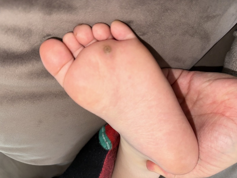 Verucca with red mark along foot???!
