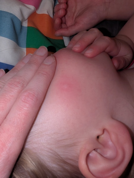 Does this look like a hive? Penicillin