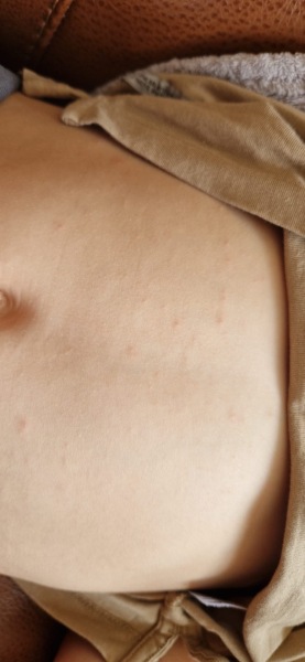 Does this look like the start of chickenpox?