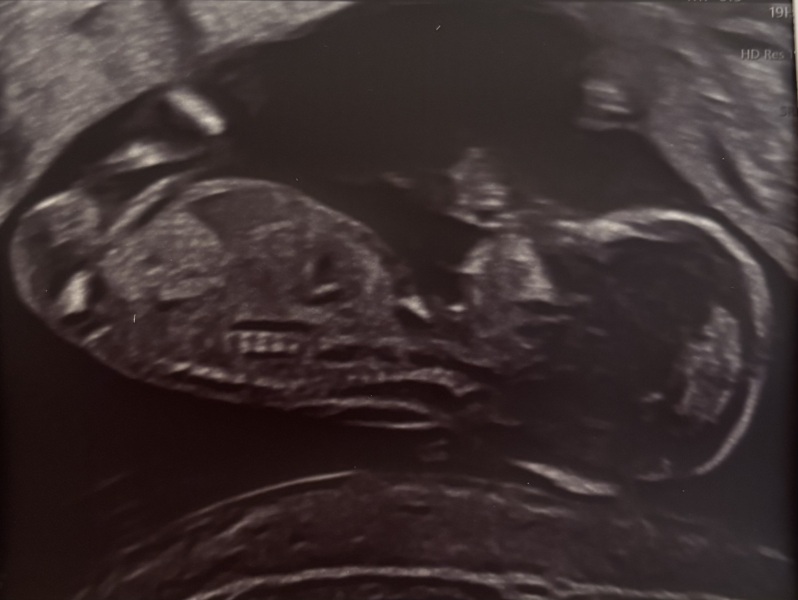Nub / skull theory.. need help