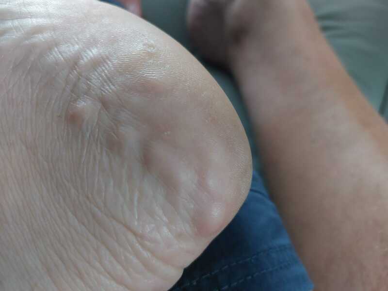 Foot lumps that 'pop' and refil