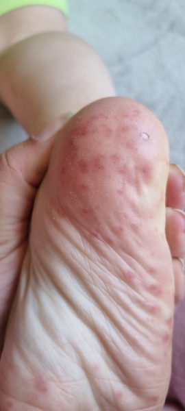 Ds Funny rash on feer