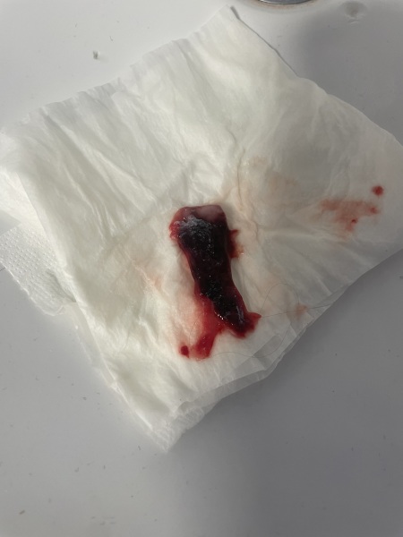 is this a clot or something different