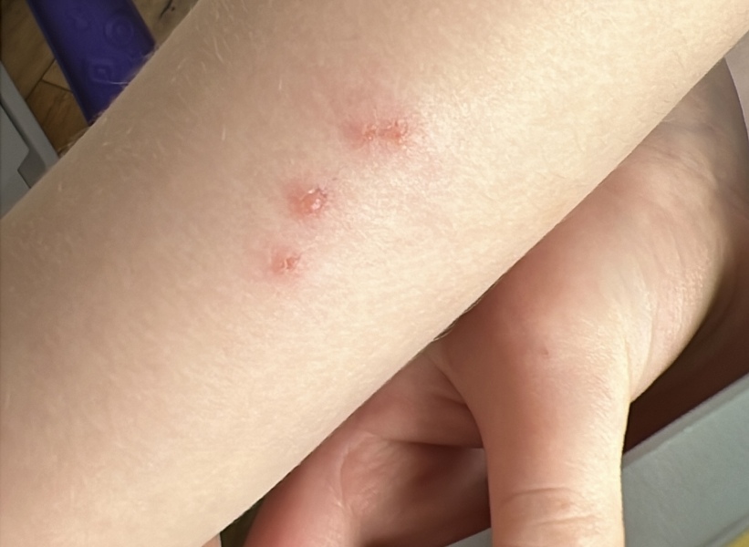 Is this chickenpox?