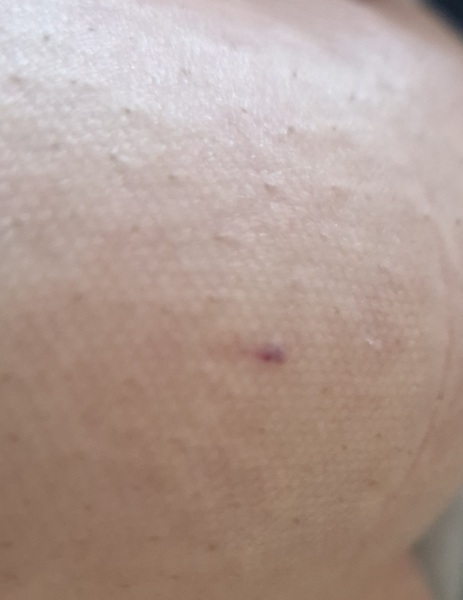 Mark under breast just a broken vein?(photo)