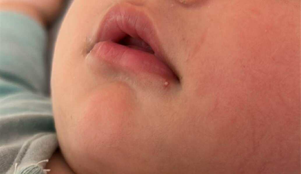 Is this a cold sore?