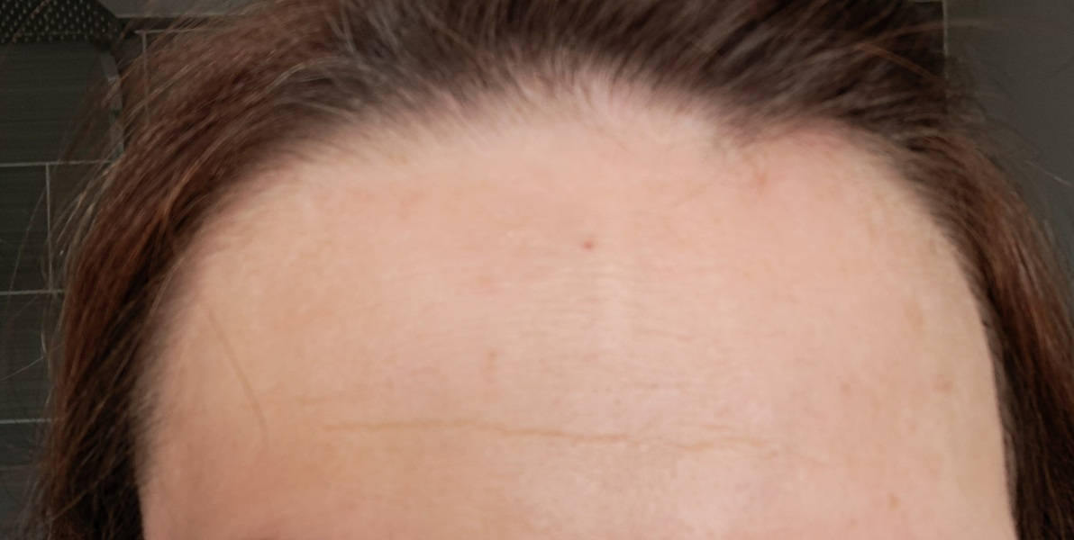 Would microneedling help?