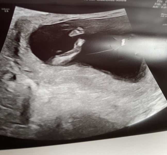 Nub theory, does it look like a boy or girl