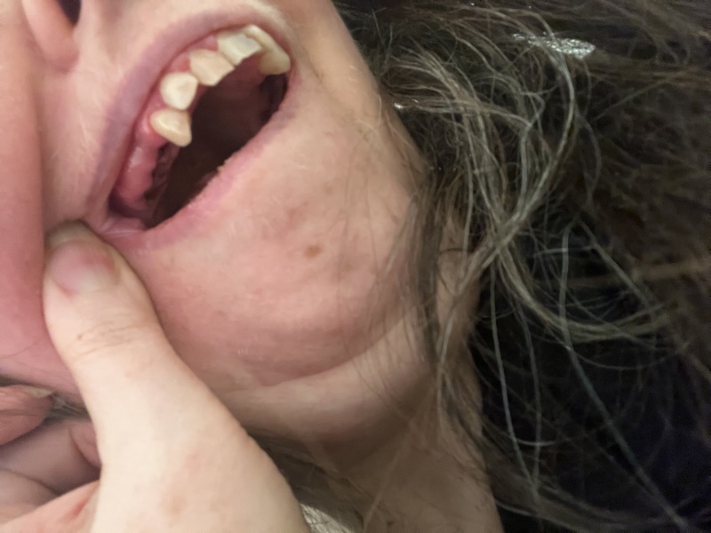 Valplast partial denture