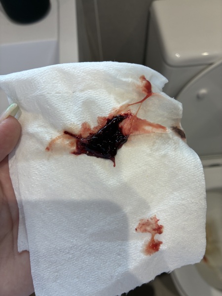 3 days PP. 1 clot - do I need to call?