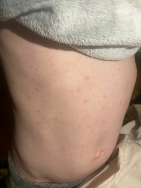 What are these spots on my son’s skin?