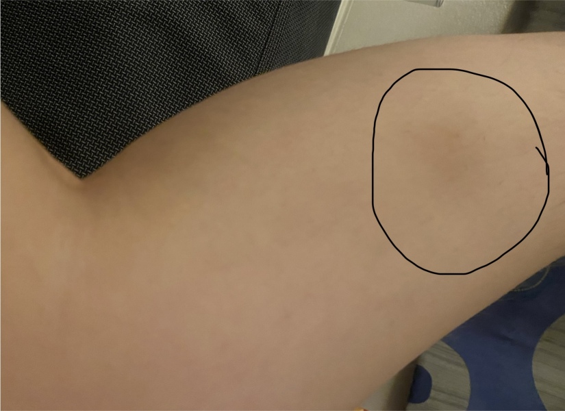 bruise-like mark on leg that isn't a bruise
