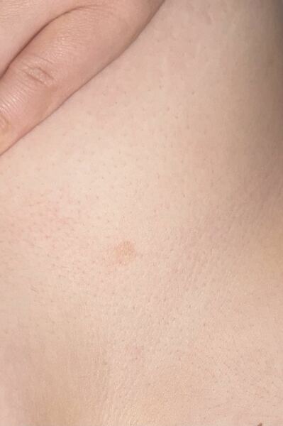 Could this be skin cancer?