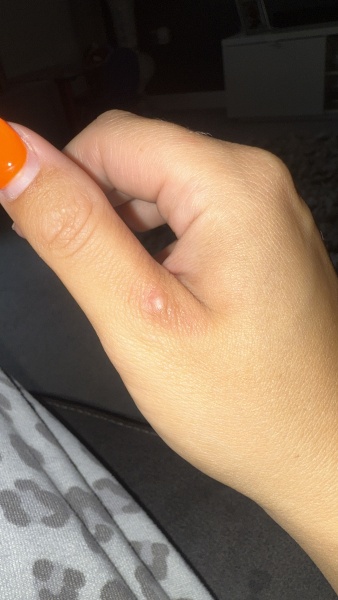 Lump on hand