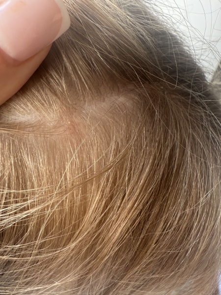 Cradle cap in 6 year old
