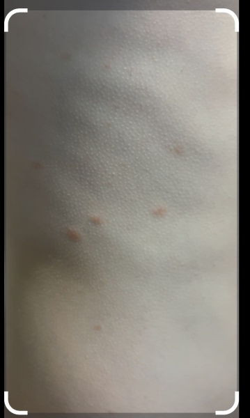 What are these spots on my son’s skin?
