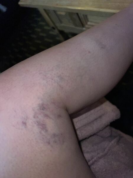 Do I need to worry about these veins?