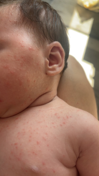 Baby acne or CMPA rash