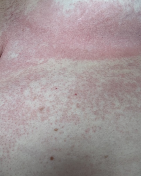 Rash pics!