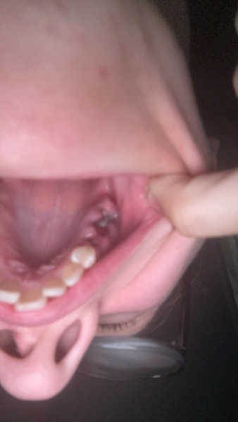 Tooth extraction is it healed or is it infected