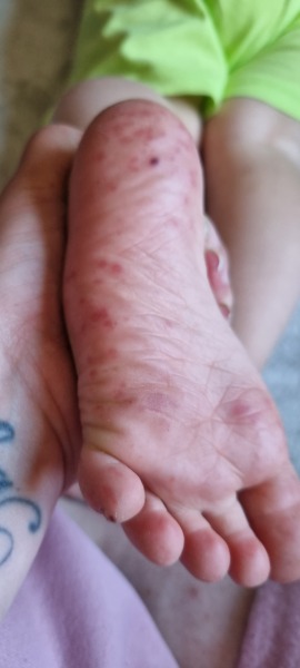 Ds Funny rash on feer