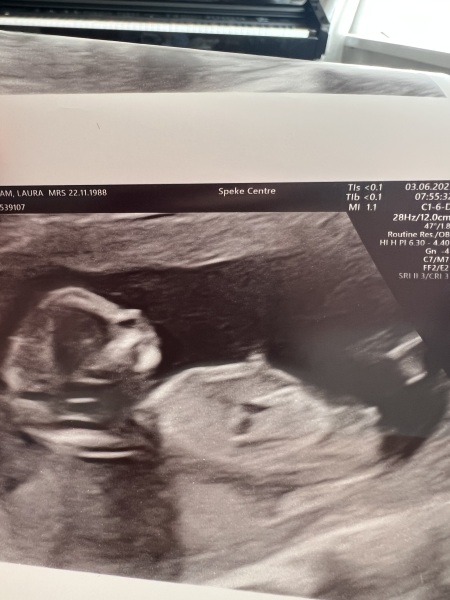 13 week scan gender prediction:))