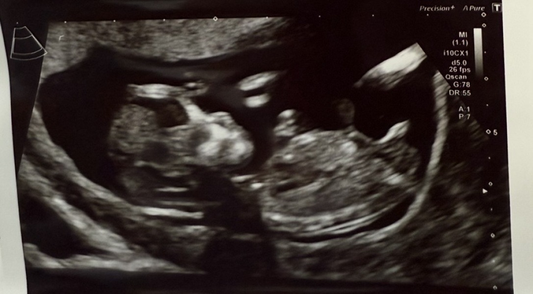 Nub / Skull theory guesses