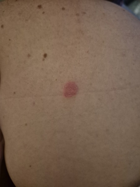 Another skin question!